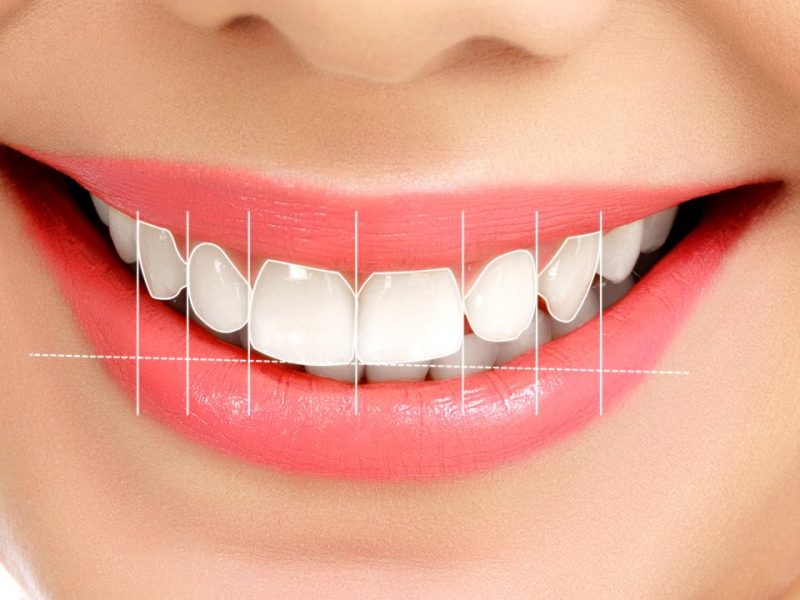 Diş Estetiği Tanılama Süreci   